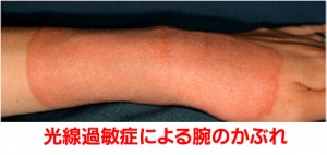 東京都江東区の接骨院、整骨院、マッサージ師の先生も肩こり、腰痛、頭痛、しびれの治療に通う整体院、南砂町駅から徒歩３分のみなみすな整体院　モーラステープ　光線過敏症